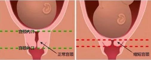 宫颈管短了会早产