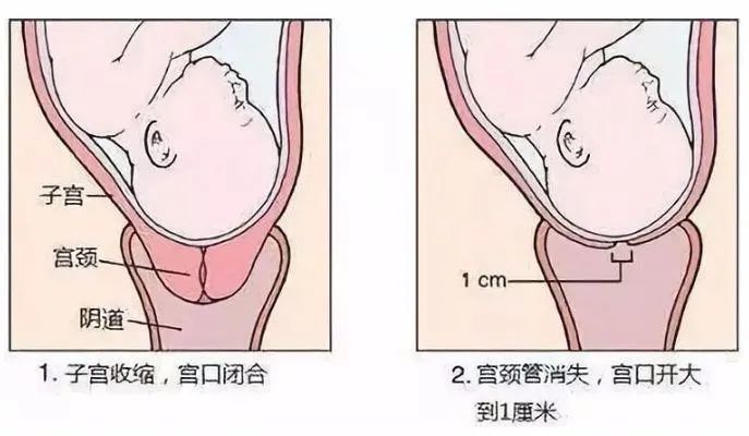 宫颈管短了会早产