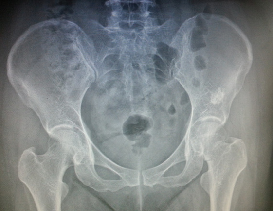 做x光片对诊断股骨头坏死的意义是什么?