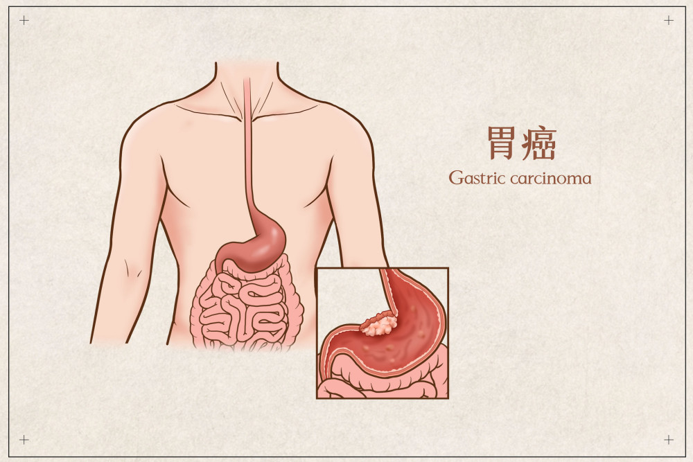 胃癌排名_胃癌晚期图片