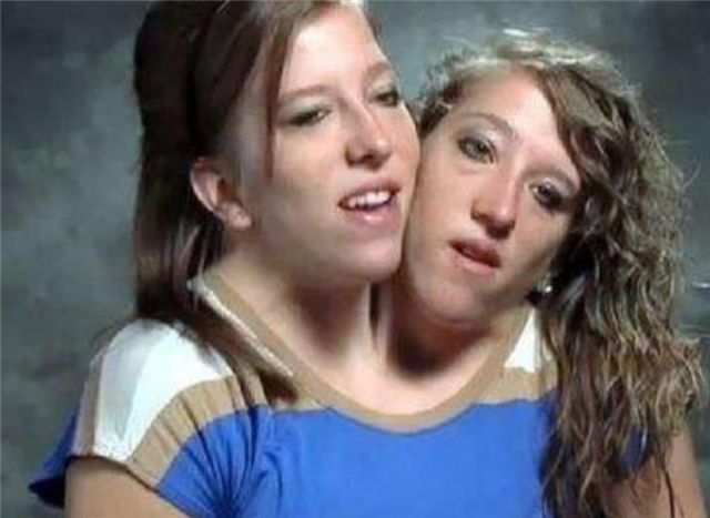 美国双头连体姐妹花:姐妹共用同一副身体,都有自己的男朋友