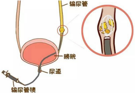 云南结石病医院:女性预防尿结石应正确治疗尿路感染和