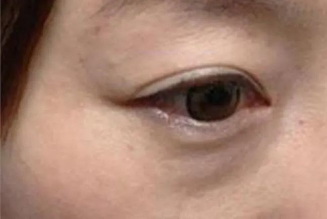 眼睛周边水肿可能有很多原因,比如睡前喝了太多水,有肾炎等,但也有