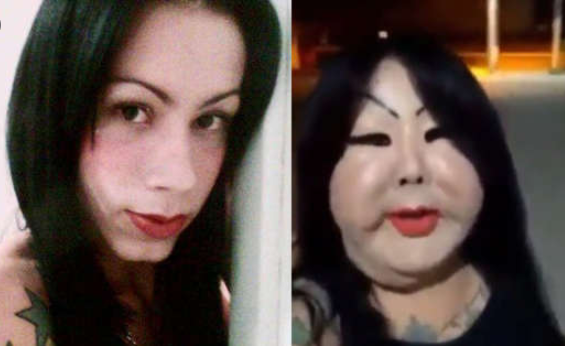 巴西女子嫌自己丑,选择注射250毫升工业硅胶:如今全脸