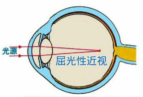 屈光性近视 角膜或晶状体曲率过大,导致眼的屈光力超出正常范围