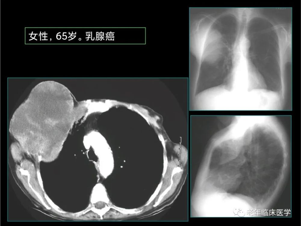 珍藏版(ct系列之七):肺其他恶性肿瘤