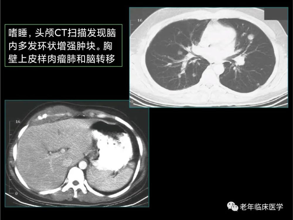 珍藏版(ct系列之七):肺其他恶性肿瘤