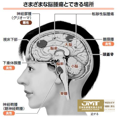 视线模糊,听力下降,小心,可能是脑膜瘤的前兆