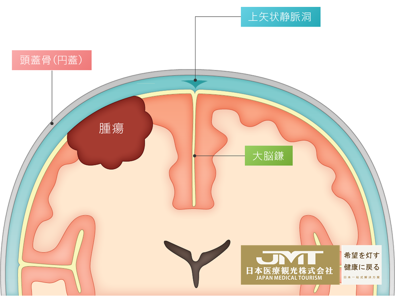 视线模糊,听力下降,小心,可能是脑膜瘤的前兆