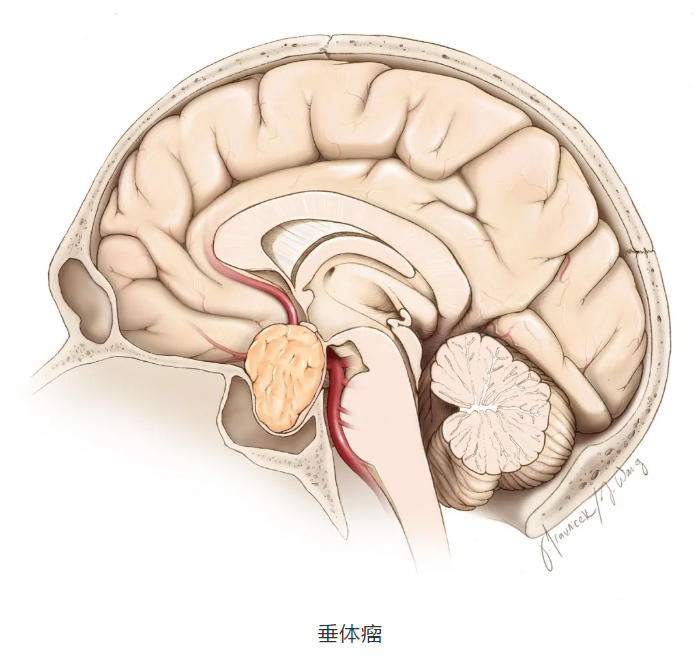 大医小说长了垂体瘤怎么办