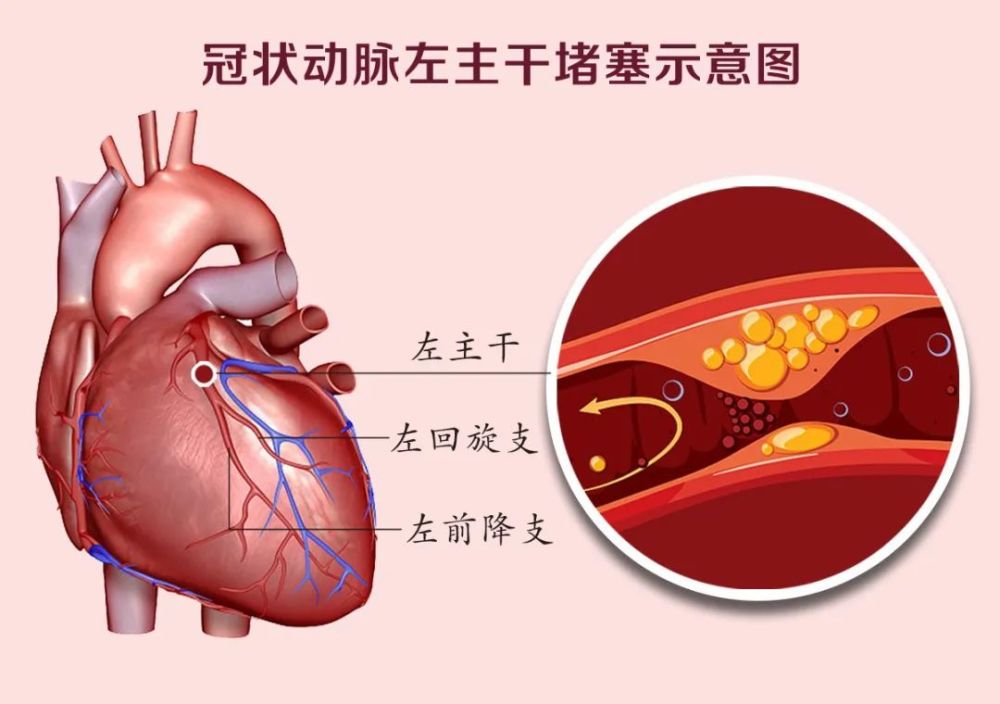 邓捷介绍,我们的冠状动脉是给心脏供血和供氧的主要动脉.