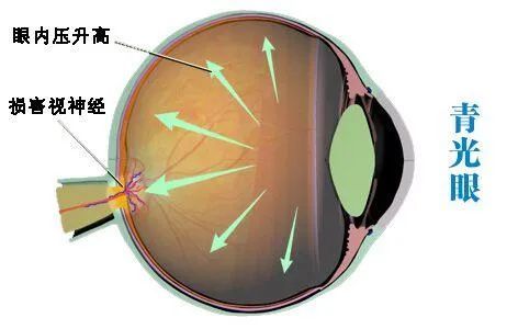 青光眼的诱发因素和前兆有哪些呢?