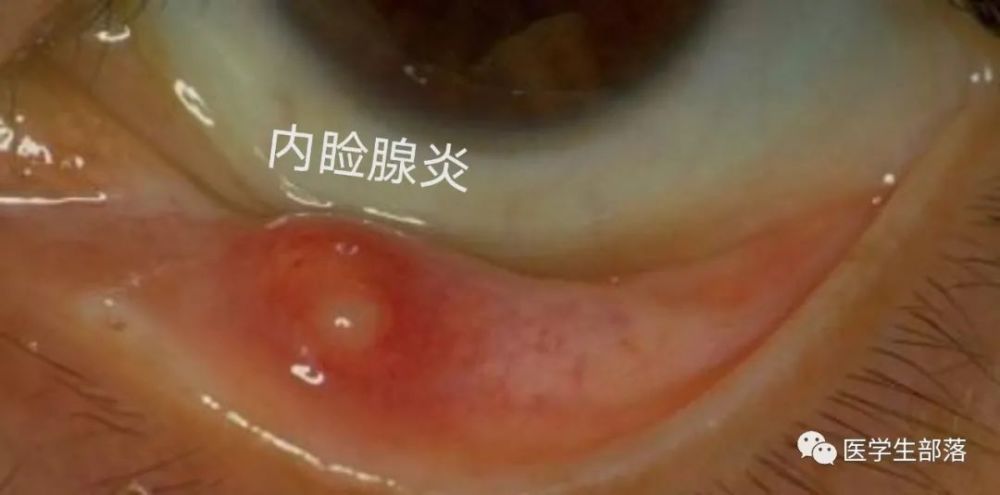 睑腺炎(麦粒肿)