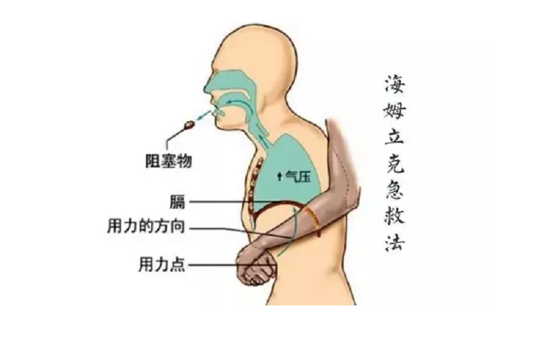 30秒|异物卡喉引窒息,护士使出救命招