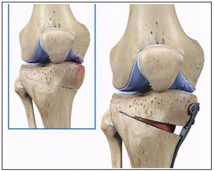 胫骨高位截骨术可以降低膝关节内侧的压力,创造适合膝关节内侧间室