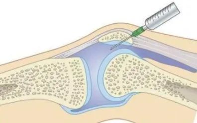 关节有积液到底要不要抽?日常如何养护?