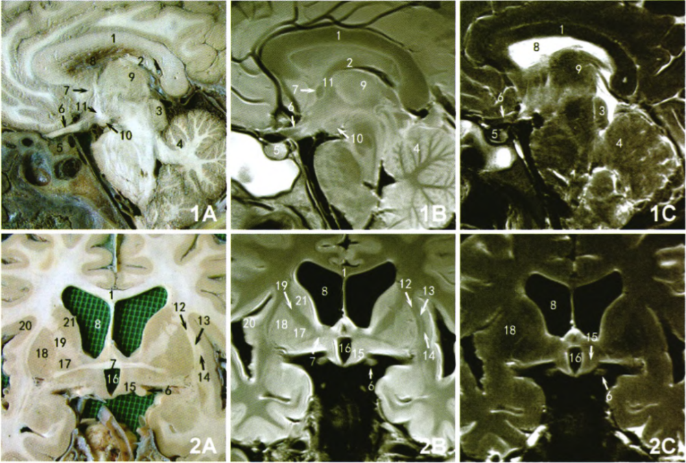 下丘脑核团的mri成像与断层解剖对比