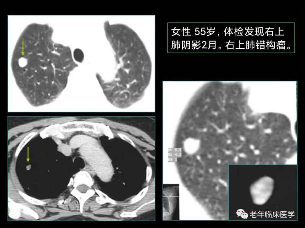 珍藏版(ct系列之八):胸部良性肿瘤