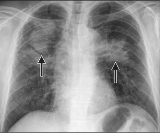 并且粉尘长期滞留在肺部组织里,导致肺部肺部纤维化的疾病