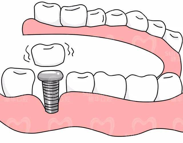 做种植牙有什么需要注意