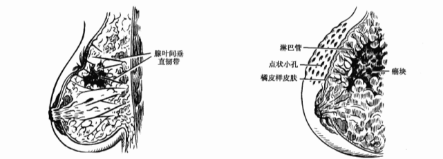 当肿块侵犯cooper韧带时,常引起肿块表面皮肤出现凹陷,称为酒窝征(见