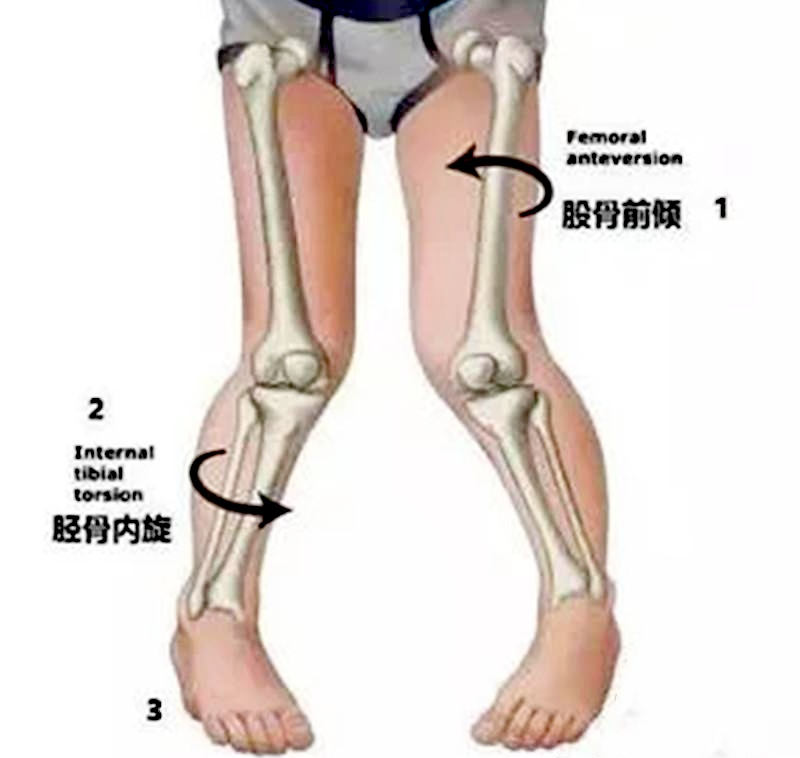 如何正确识别和矫正儿童"八字脚"?