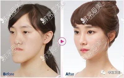 双鄂手术在韩国做还是在国内做?各有优势!