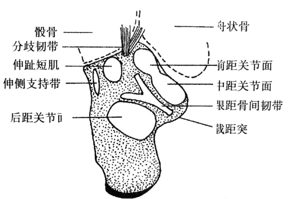 跟骨骨折分型