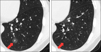 体检查出肺磨玻璃结节,是不是肺癌呢?