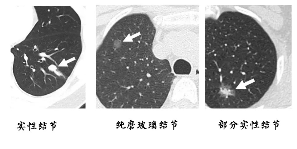 体检查出肺结节,我离癌症还有多远