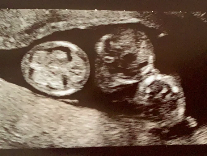 罕见的自然受孕同卵三胞胎 英国妈妈七分钟内 顺利生下三子