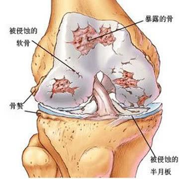 半月板后角撕裂怎么治疗最好