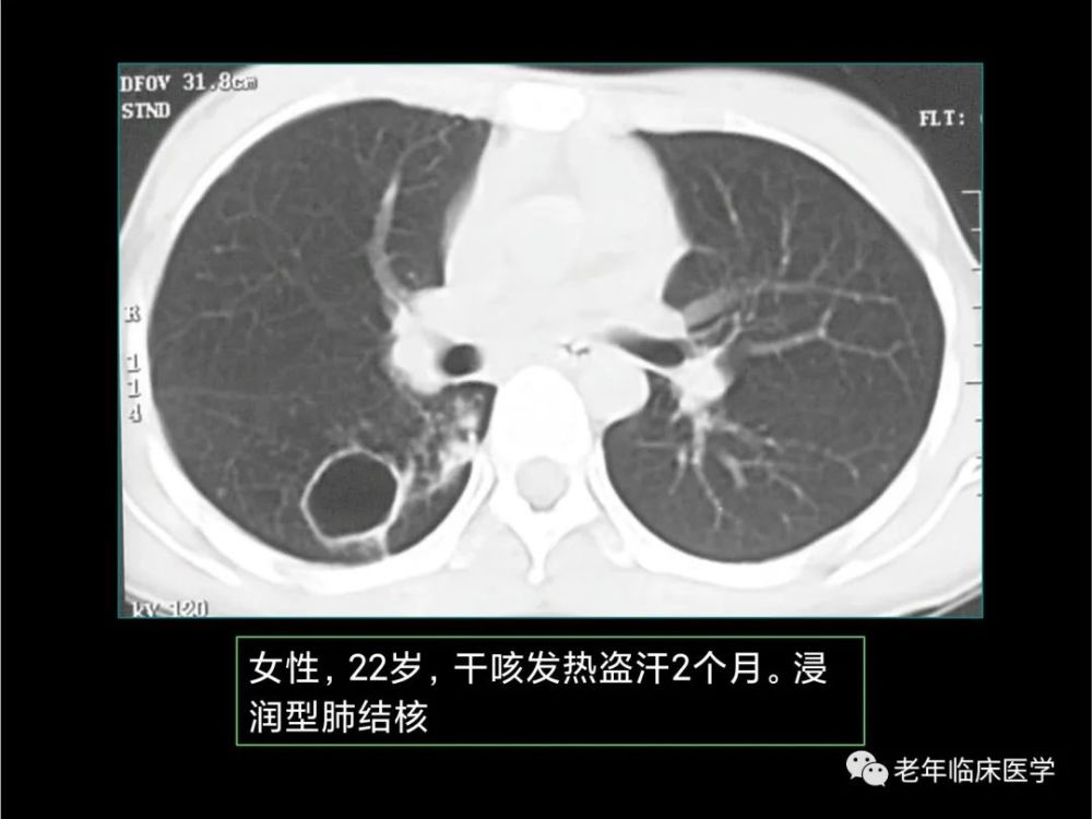 珍藏版(ct系列之九):肺结核