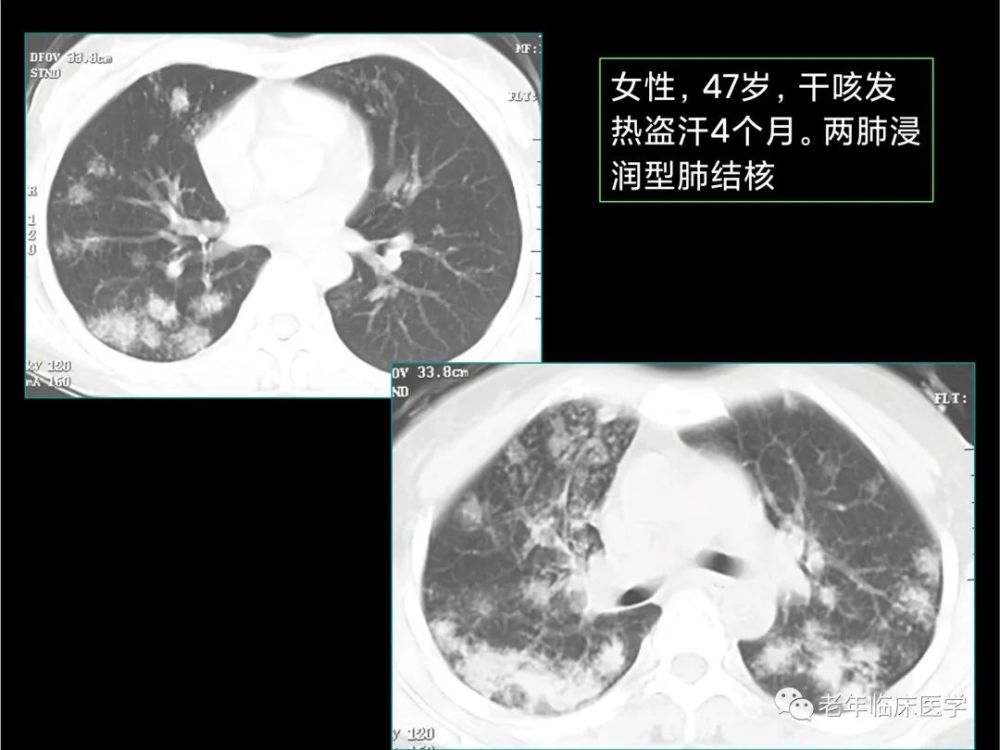 珍藏版(ct系列之九):肺结核