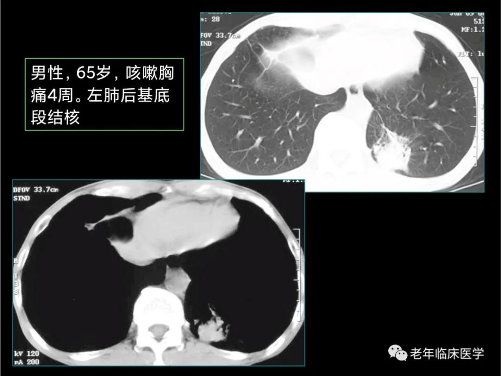 珍藏版(ct系列之九):肺结核