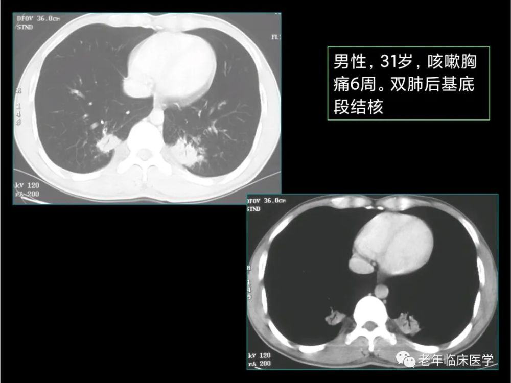 珍藏版(ct系列之九):肺结核