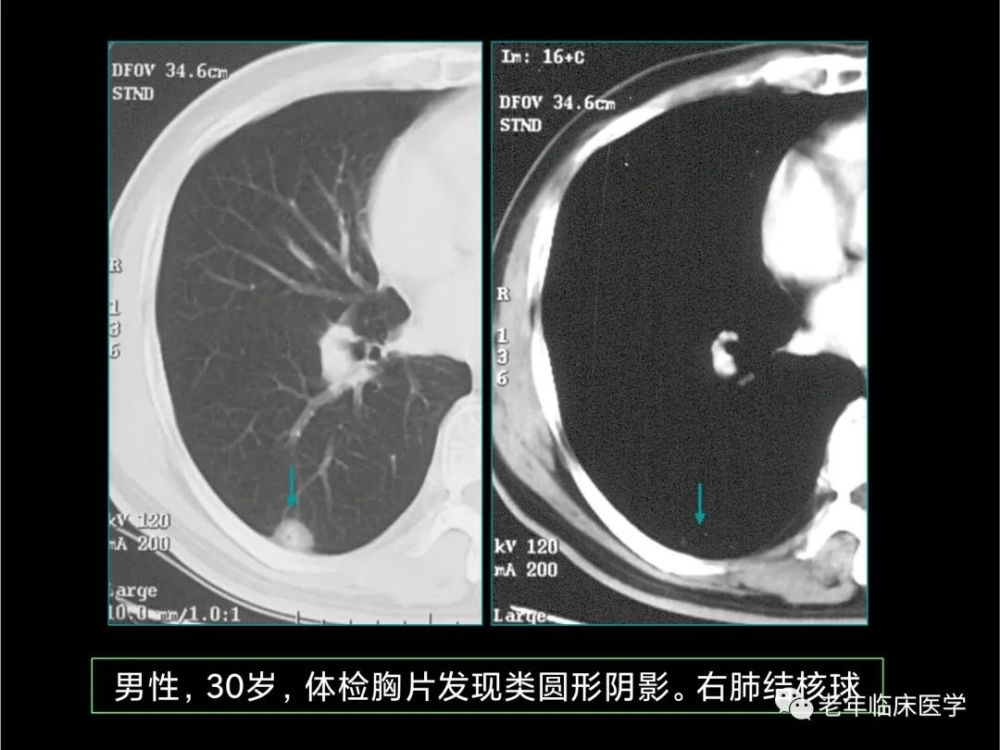 珍藏版(ct系列之九):肺结核