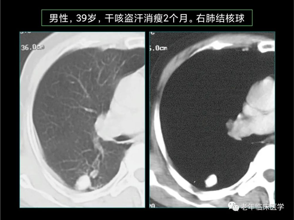 珍藏版(ct系列之九):肺结核