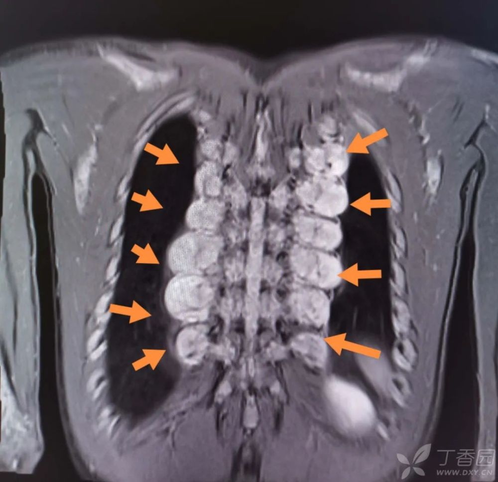 男,26 岁.双侧脊柱旁多发肿块,呈「串珠状改变.