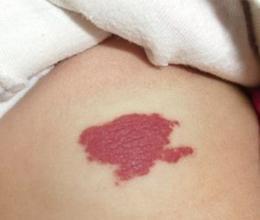 三,新生儿血管瘤要怎么办4,营养不良因素:在婴儿毛细血管瘤的形成原因