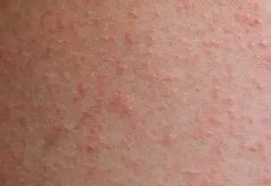 胆碱能性荨麻疹:一种洗个热水澡都要"作妖"的皮肤病