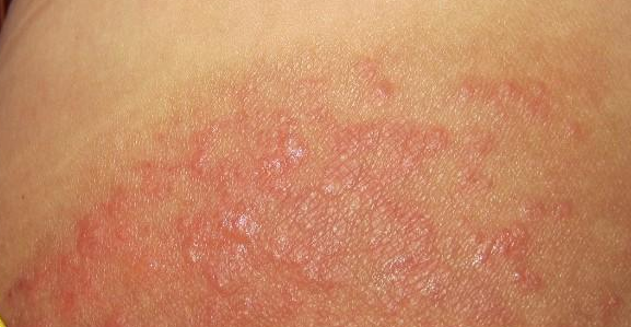 真菌感染诱发哪些皮肤病,是否传染?