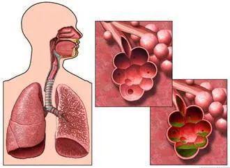 肺气肿和慢性支气管炎是慢性阻塞性肺疾病的两种表现特征