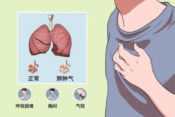 什么是阻塞性肺气肿