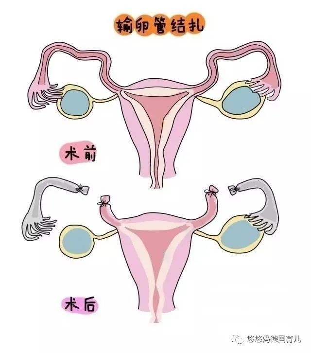 而女性的输卵管在体内是需要在肚子上开个小口,所以创伤会更大.