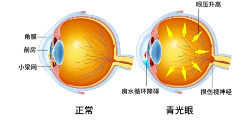 【 03 】 青光眼爱找谁? ●高度近视患者 开角型青光眼发病率 增高.