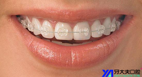 成人牙齿正畸真的堪比整容吗?你又了解多少?