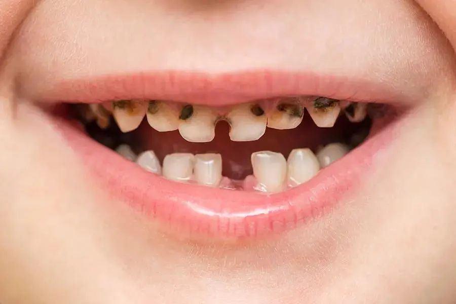 儿童牙齿保护攻略,北斗星的目标是没有蛀牙