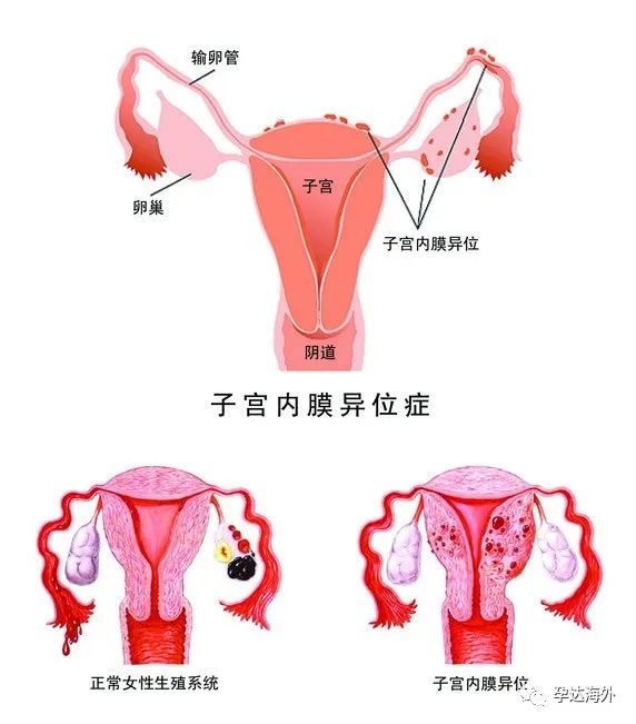 想要怀孕,子宫内膜厚度多少才合适呢?孕达国际试管科普