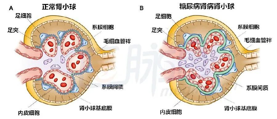 2,血尿,红细胞挤出肾小球的基底膜时会被挤变形,所以如果是肾小球源性